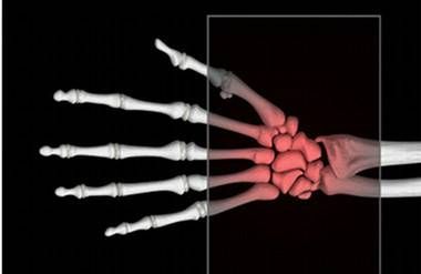 an x-ray of a hand with the wrist in red