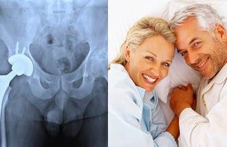 Boomers are discovering the side effects of getting new hips or knees: better se