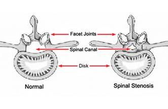 spinal stenosis illustration
