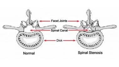 ilustrare stenoză spinală