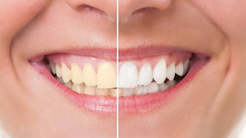 Using hydrogen peroxide to whiten your teeth