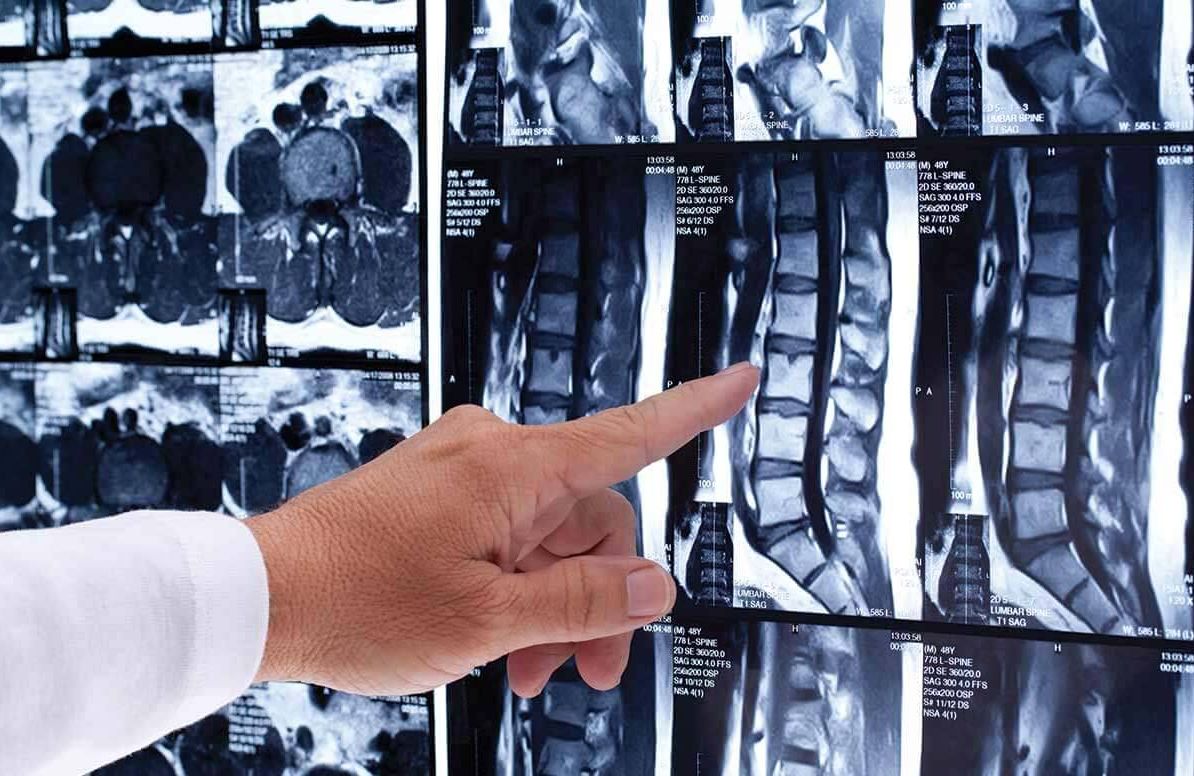 Doctor reviewing spine x-ray