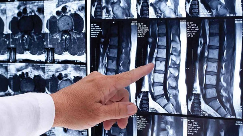 Doctor reviewing spine x-ray