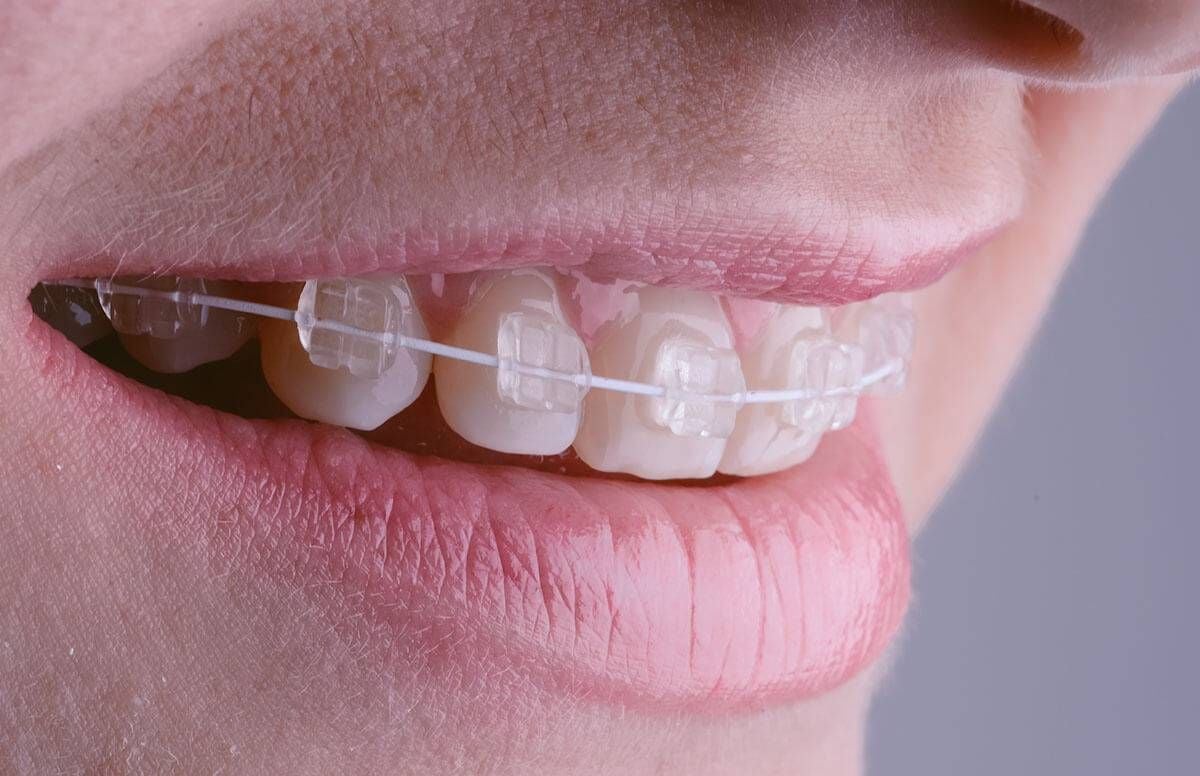 Common Concerns Surrounding Adult Braces