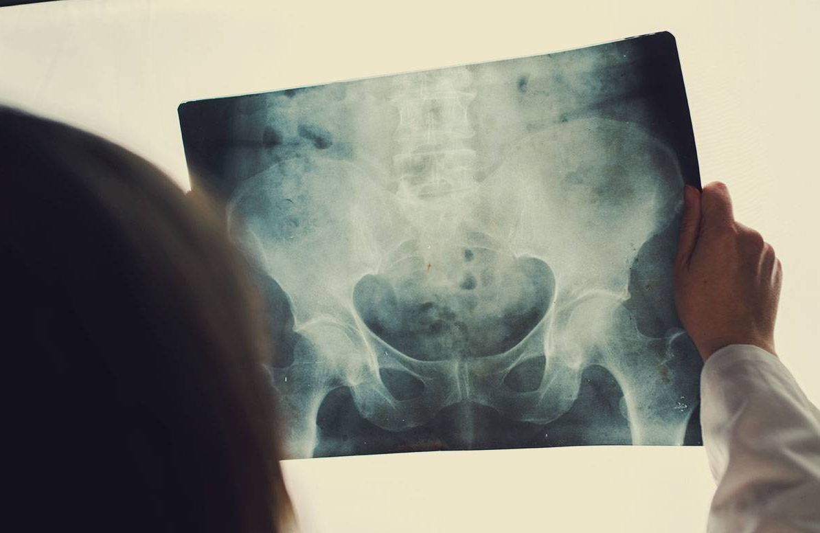 Hip Xray being examined by a doctor