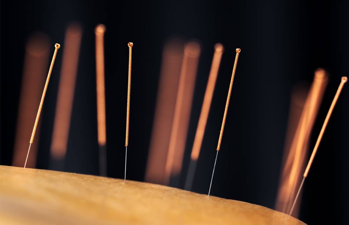 Acupuncture needles