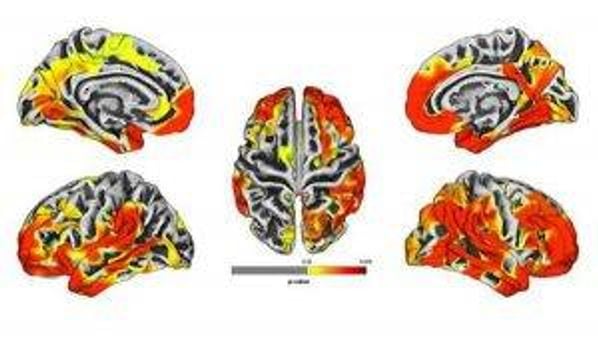 The brain images are a compilation of MRI results of 9/11 responders. The images show gray matter atrophy on the brain with yellow and red areas revealing statistically significant atrophy compared to the normal population. Red areas show worse atrophy than yellow.