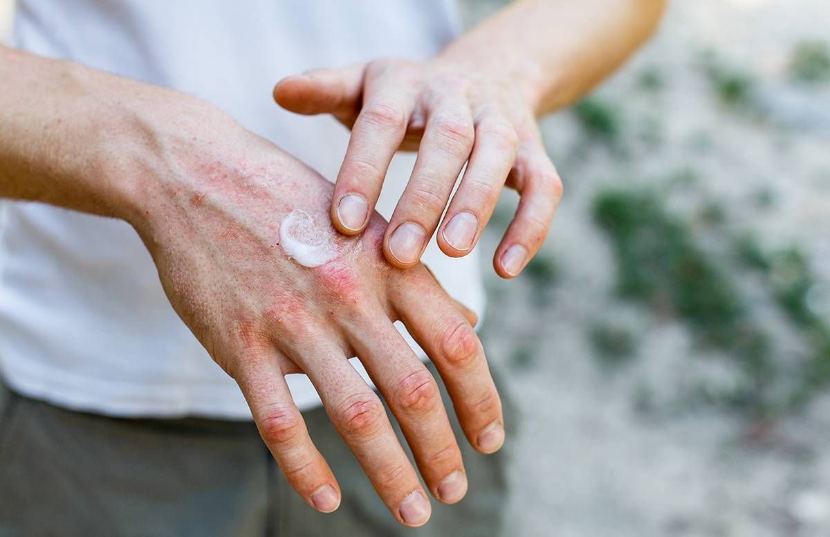 What You Need to Know About Adult Eczema | Next Avenue