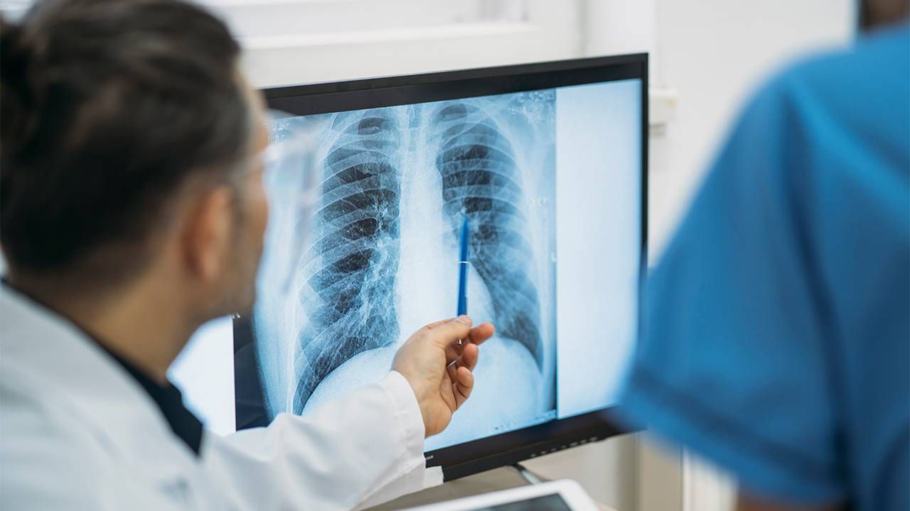 Doctor looking at a Xray of a lung. Lung cancer, cancer survivor, Next Avenue