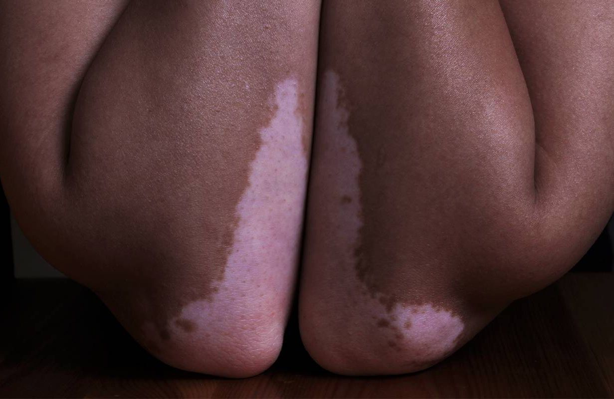 Close-up of a person with vitiligo. Next Avenue