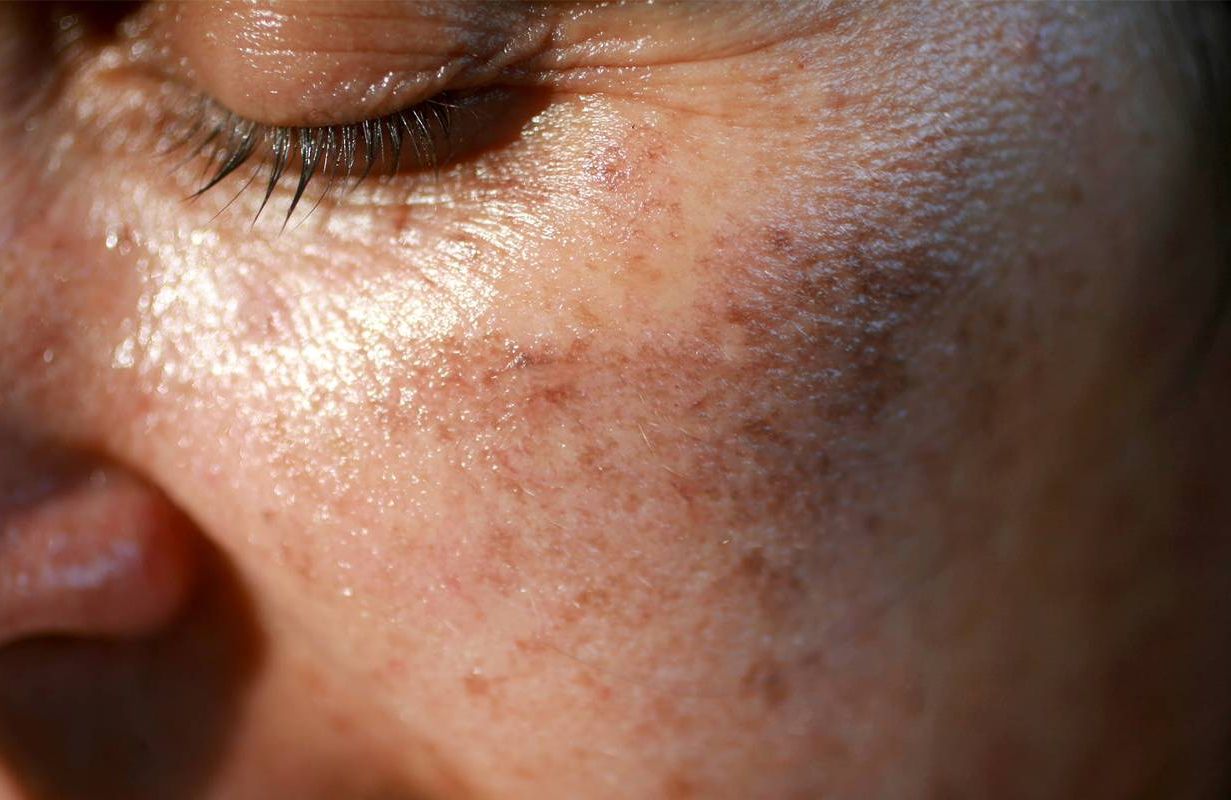 A close-up shot of a woman's face with small sun spots. Next Avenue, skin aging, sun damage