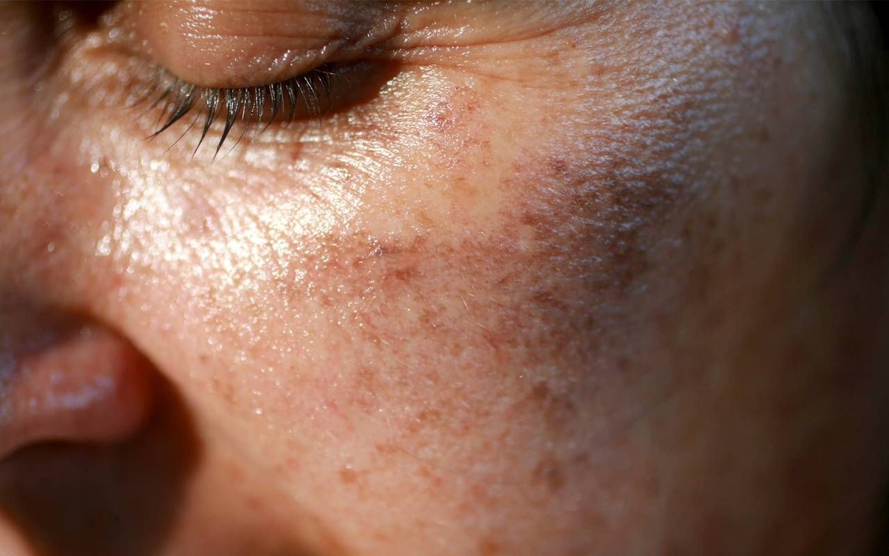 A close-up shot of a woman's face with small sun spots. Next Avenue, skin aging, sun damage