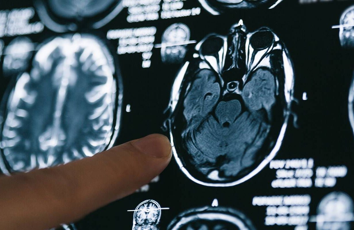 A researcher pointing at an MRI scan of a human brain. Next Avenue, alzheimer's, dementia, brain, aging