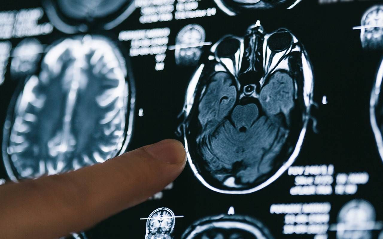 A researcher pointing at an MRI scan of a human brain. Next Avenue, alzheimer's, dementia, brain, aging