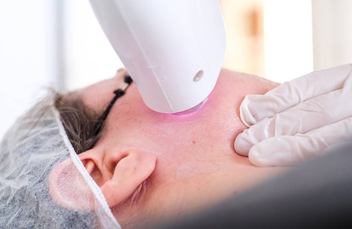 A person getting an IPL laser treatment for sun damaged skin. Next Avenue